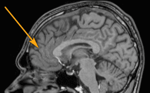 impact of cannabis on the adolescent brain